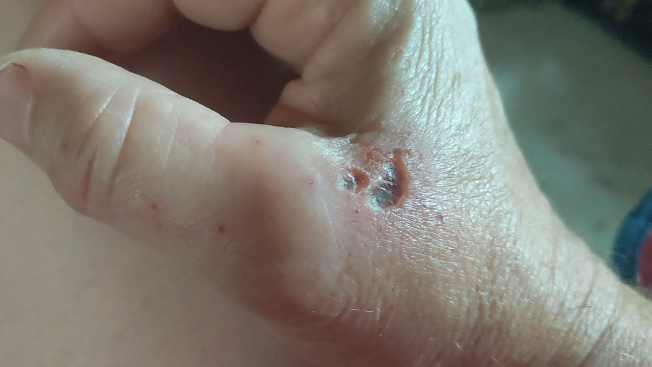 Drain cleaners will eat a hole in your skin! YouTube