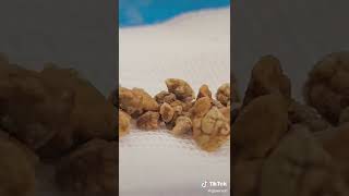 Удаление камней из почки без разрезов (эндоскопически)