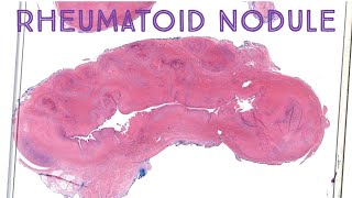 Rheumatoid Nodule - Palisaded Necrobiotic Granuloma in Rheumatoid Arthritis (Emory case 1)