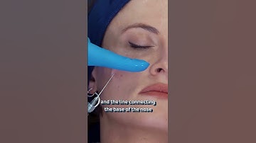 Medial Midface: Cheek Filler with Cannula | GEM© by Harley Academy-Informed Injection Technique