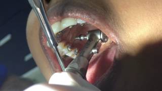 Insertion of the mini implant palataly with angulated screw driver, palatal tad placement