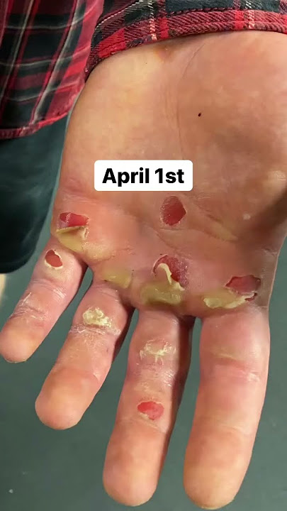 4100 pull-ups done in 17 and a half hours. Easy day!