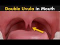 Bifid Uvula | Symptoms, Causes And Treatment (Urdu/Hindi)