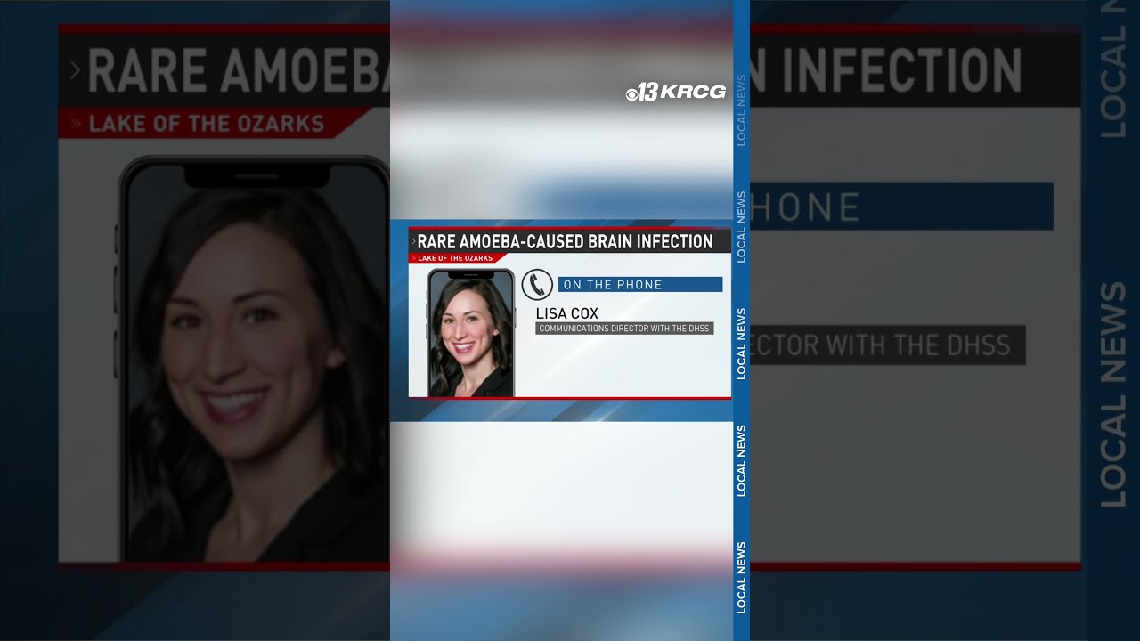 Missouri Health Officials Confirm Case Of Rare Amoeba Caused Brain Infection