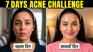 7 Days Acne Challenge : PIMPLES Dark Spots को कहें Bye-Bye और पाए साफ Healthy Looking Skin💕