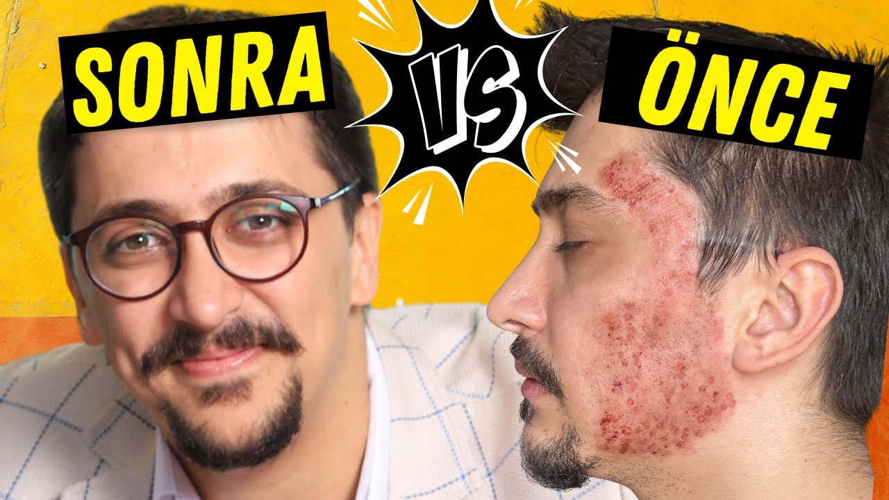 Sivilce İzleri Nasıl Geçer 😳 NET ÇÖZÜM 🩺Doktordan Cilt Bakımı Önerileri💧