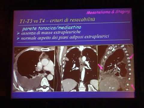 Video: Efficacia Diagnostica Dei Metodi Di Imaging E Biopsia Per Mesotelioma Peritoneale In Un Polpaccio