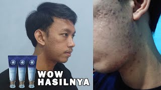 REVIEW JUJUR SKIN CARE AIZEN ' ELIXSKIN '  (GAK SESUAI EKSPETASI) | AcneStory #4