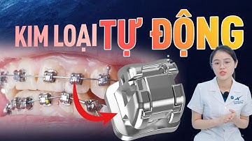 Mắc Cài Kim Loại Tự Động: 4 Lợi Ích "Siêu To" Khi Niềng Răng Mắc Cài Kim Loại Tự Động, Nhất Là Số 1