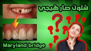 افضل جسر اسنان لتعويض الاسنان الامامية المفقودة || #عجائب_طب_الاسنان || maryland bridge