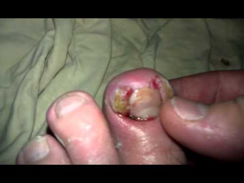 fingernail infection