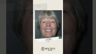 Linda’s before and after! #fullmouthdentalimplants #dentalimplants