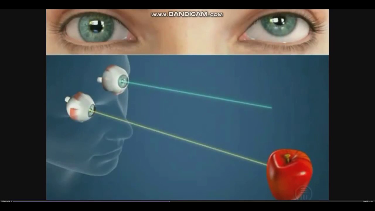 как видит касоглазые люди. поле зрения собаки и человека. как видит человек при амблиопии. зрение при астигматизме. как видит человек при косоглазии.