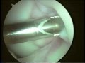 Arthroscopic knee surgery for torn cartilage  chondroplasty