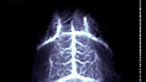 Non-Invasive Imaging of Brain Vasculature Using NIR-II Fluorescence
