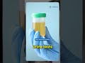 Chronic Kidney Disease Treatment in India: The Truth Nobody Tells You #kidneydisease#healthcareindia