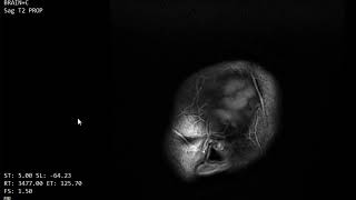 Case 1125 MRI INTRAVENTRICULAR NEUROCYTOMA