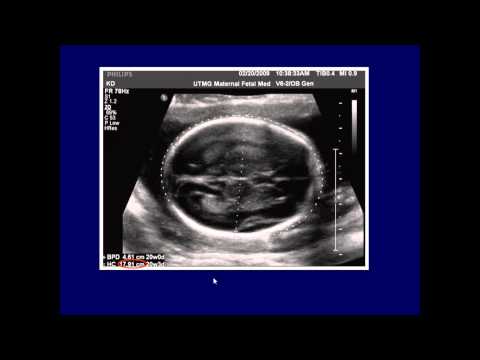 Video: Dab tsi yog fetal biometry?