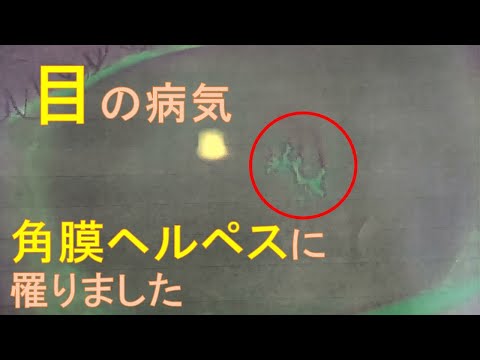 【角膜ヘルペス】目にヘルペスができていると眼科で診断され、治療を始めてから1週間のご報告。