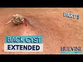 Part 13 massive back cyst extended  huevine