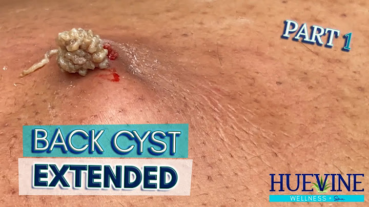 Part 1/3- Massive Back Cyst, Extended | HueVine