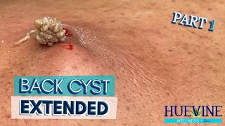 Part 13- Mive Back Cyst, Extended Huevine