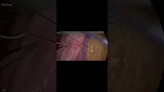 Laparoscopy simulator for DCP surgery
