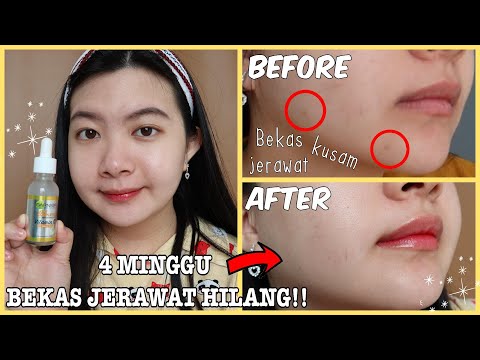 SKINCARE ROUTINE UNTUK MUKA BERJERAWAT | saritiw. 