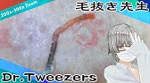 063 0x Zoom 白い毛根鞘 Dr Tweezers 毛抜き先生の角栓や毛根 Youtube 063 0x Zoom 白い毛根鞘 Dr Tweezers 毛抜き先生の角栓や毛根 Youtube