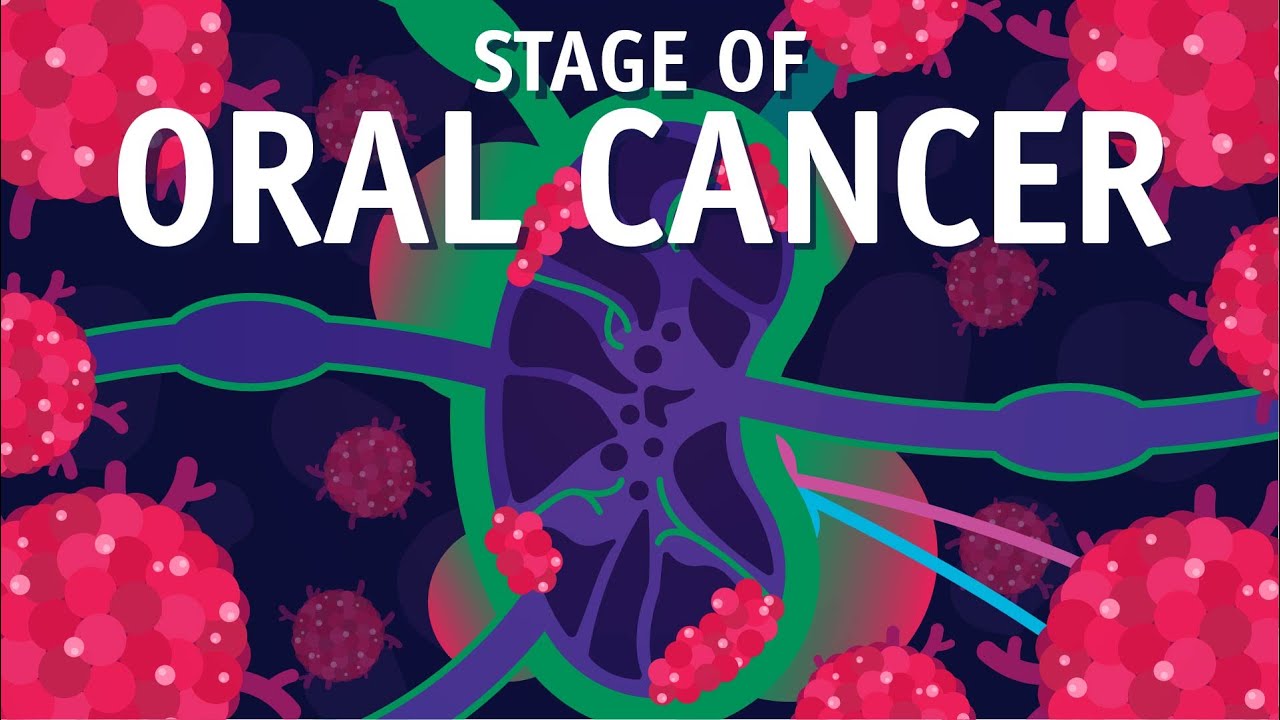 What is TNM Staging? How do We do Staging of Oral Cancer?