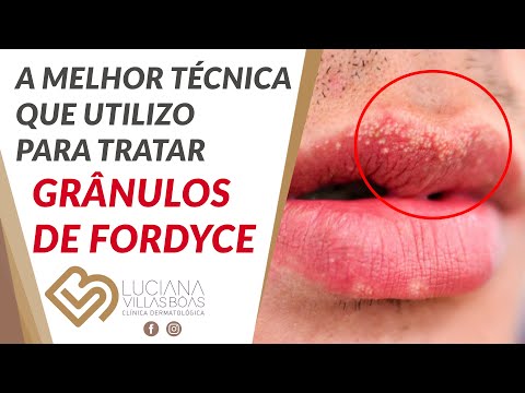 Vídeo: Solavancos Brancos Nos Lábios: Causas, Tratamentos E Muito Mais