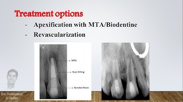 Open apex - Diagnosis and treatment options