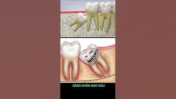 Bạn đã sợ răng khôn chưa :)