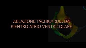 Parahisian accessory pathway: mapping and ablation