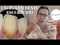 🔥FACETAS EM DENTES ESCURECIDOS: AGORA COM ESTAS RESINAS FICOU MAIS FÁCIL!🤯😳🤩🚀