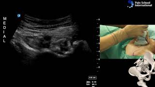 Dr Agnes Stogicza - Cryoablation E-Learning Seminar 1 Session 1: Hip denervation