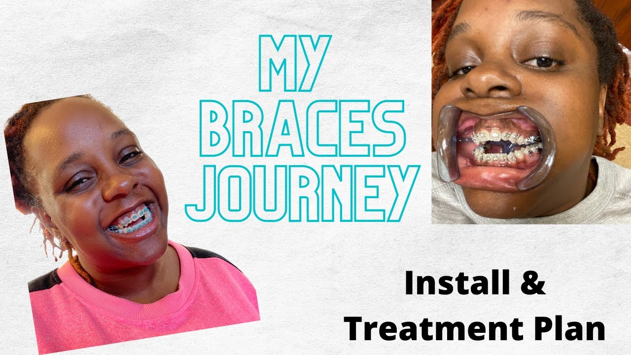 Adult Braces JourneyOpen Bite/Cross bite[Install]No jaw surgery YouTube