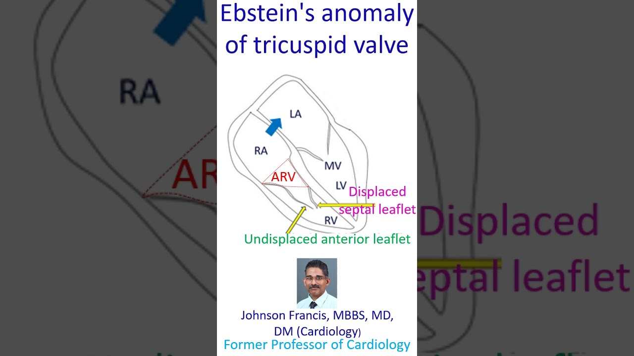 Ebstein's anomaly of tricuspid valve