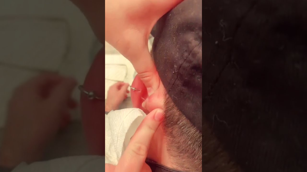 Stubborn Cyst