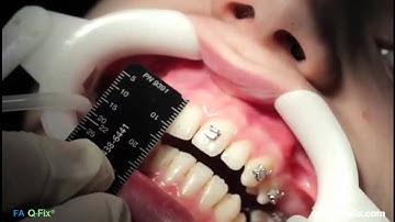 FAQFix - Direct Technique - Step 2 - Measure clinical crown height.mp4