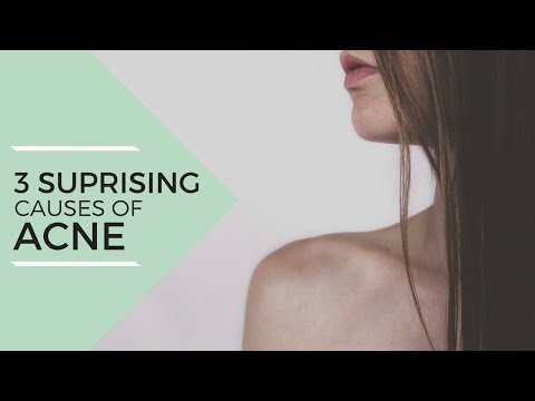  Surprising Causes of Acne + Natural Remedies // Laura&#;s Natural Life