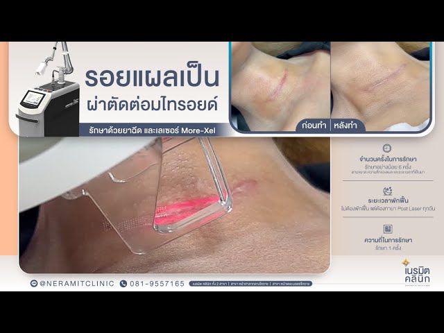 รักษาแผลเป็น EP.7 /แผลเป็นจากการผ่าตัด More-Xel Laser @หมอปุ๊ Neramit Clinic