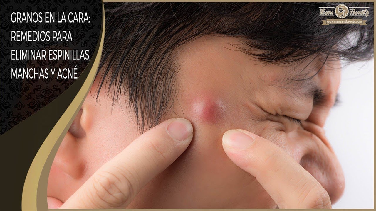 Como Quitar Granos En La Cara / Como Quitar Los Granos YouTube