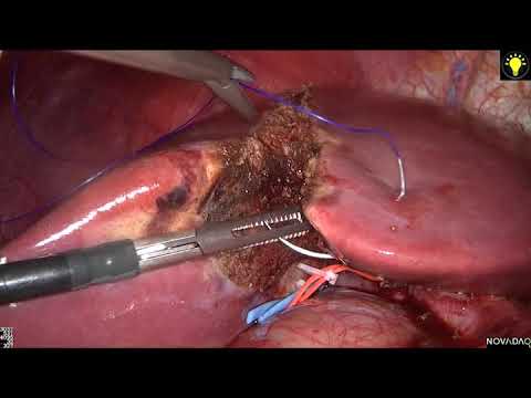 LAPAROSCOPIC FULL RIGHT DONOR HEPATECTOMY A STANDARDIZED STEPWISE PROCEDURE INCLUDING COUNTERSTAININ