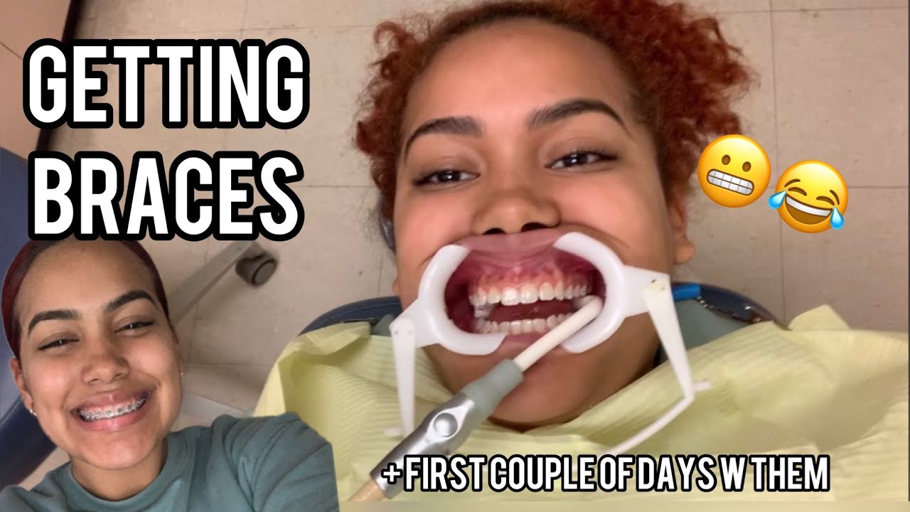 GET BRACES WITH ME!! + FIRST COUPLE OF DAYS WITH THEM (Painful