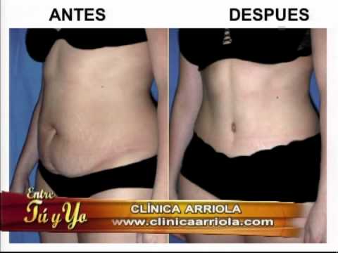 Abdominoplastía: consigue un abdomen estético