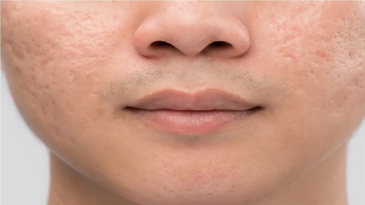 Лечение Ветрянка у взрослых - угроза жизни