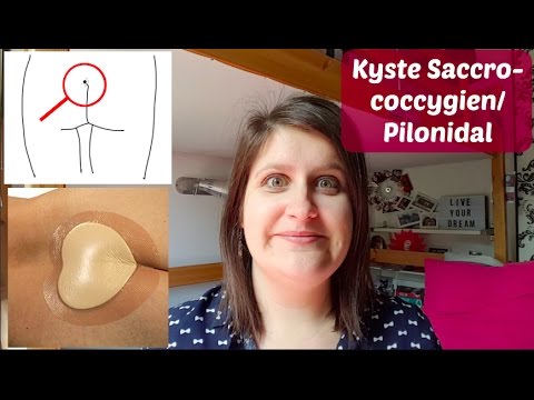 Vidéo: Chirurgie Du Kyste Pilonidal: Procédure, Récupération Et Récidive