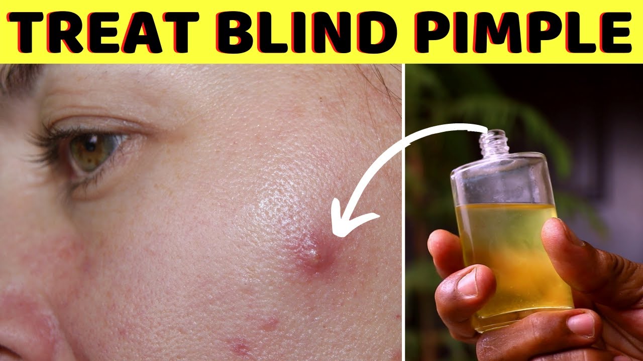 How To Get Rid Of A Blind Pimple With No Head Fast Overnight Youtube