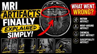 MRI Artifacts FINALLY Explained Simply 4 You Must Know